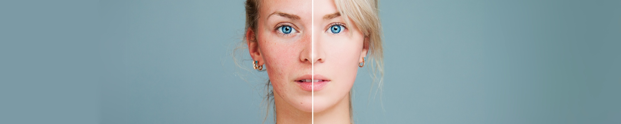 Rosacea Die richtige Behandlung bei Rosacea