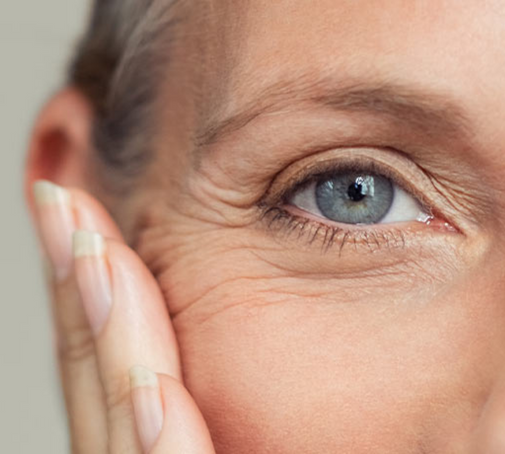 What are crow’s feet?