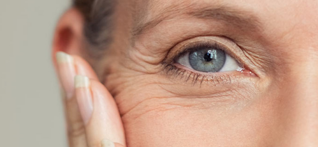 What are crow’s feet?