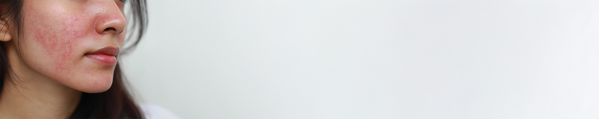 Was tun bei Couperose