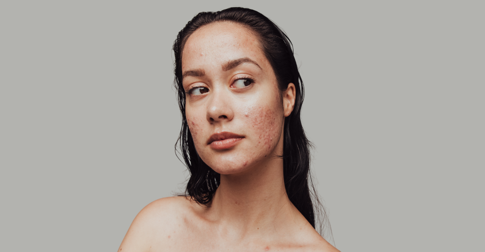 Skincare for Blemish-Prone skin Blemish skincare