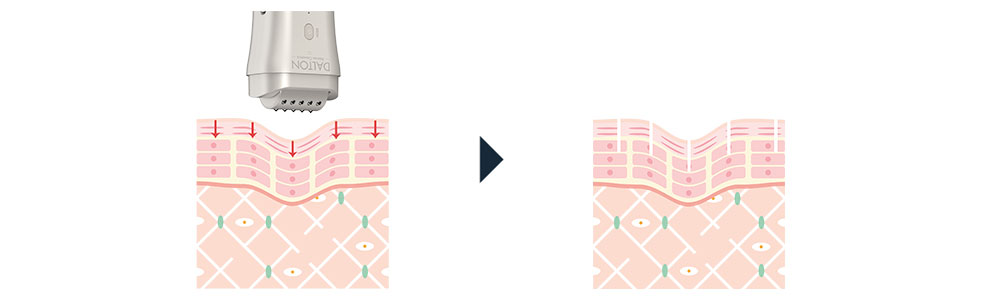 SkinFuison II erster Anwendungsschritt