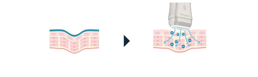SkinFuison II zweiter Anwendungsschritt