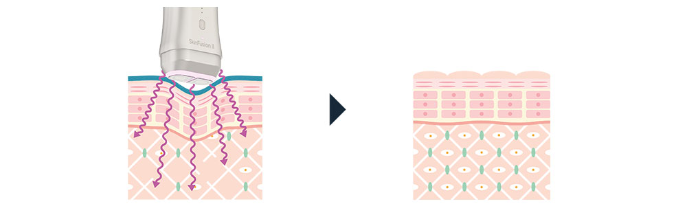 SkinFuison II dritter Anwendungsschritt