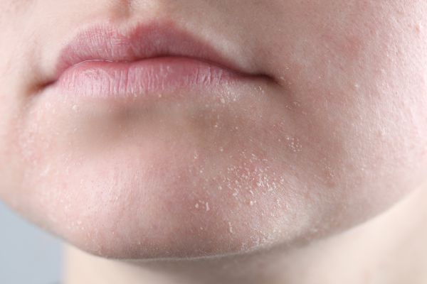 Trockene Haut im Winter