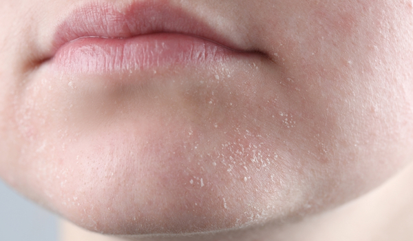 Trockene Haut im Winter