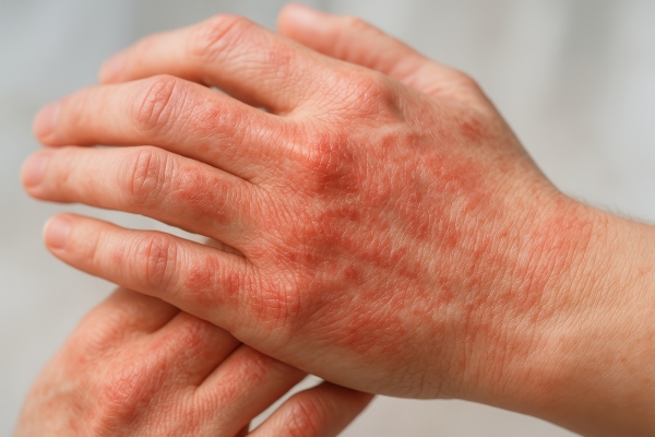 Winterekzem Beispiel